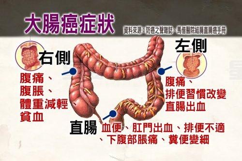 Colorectal Cancer 3