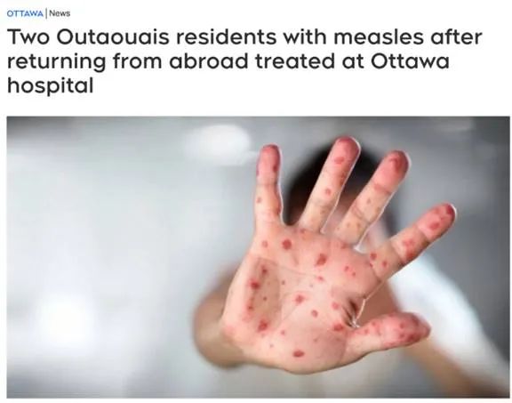 加拿大新冠住院反弹 医院告急! 2人确诊荨麻疹 加拿大新冠住院反弹 医院告急! 2人确诊荨麻疹