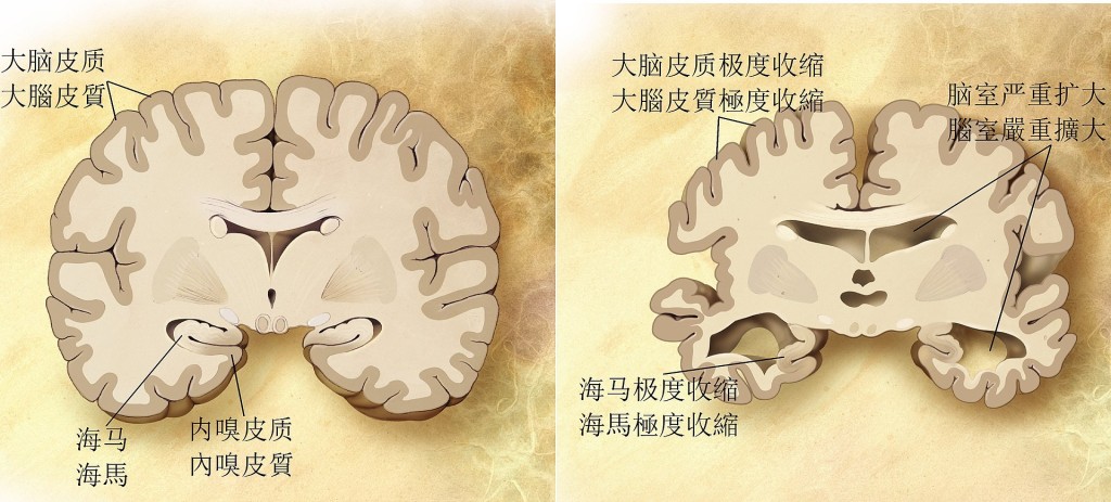 患老年痴呆症大脑（右）和正常的大脑有明显分别。