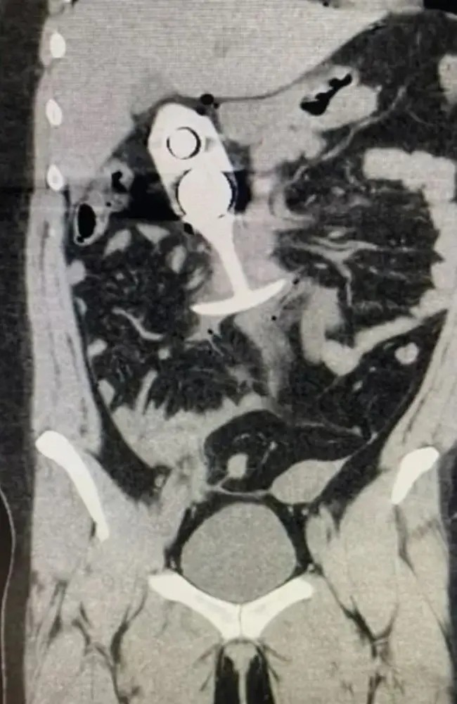 肛塞穿过女子身体,致她身受重伤。路透社 肛塞穿过女子身体,致她身受重伤。路透社
