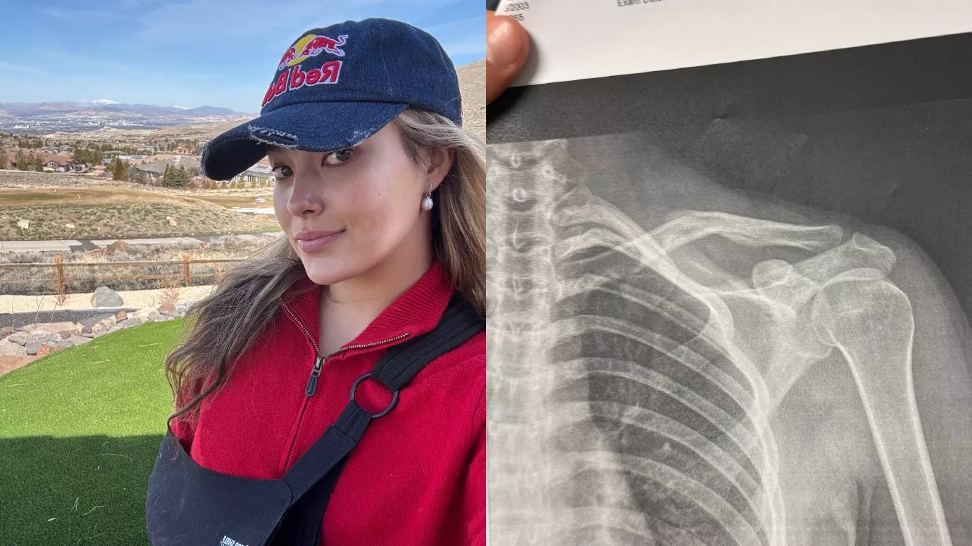 谷爱凌微博晒出骨折X光片 曾因伤退出哈尔滨亚冬会